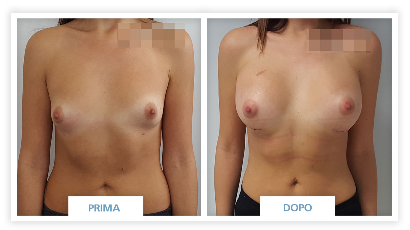 foto aumento del seno prima e dopo cice 2.1